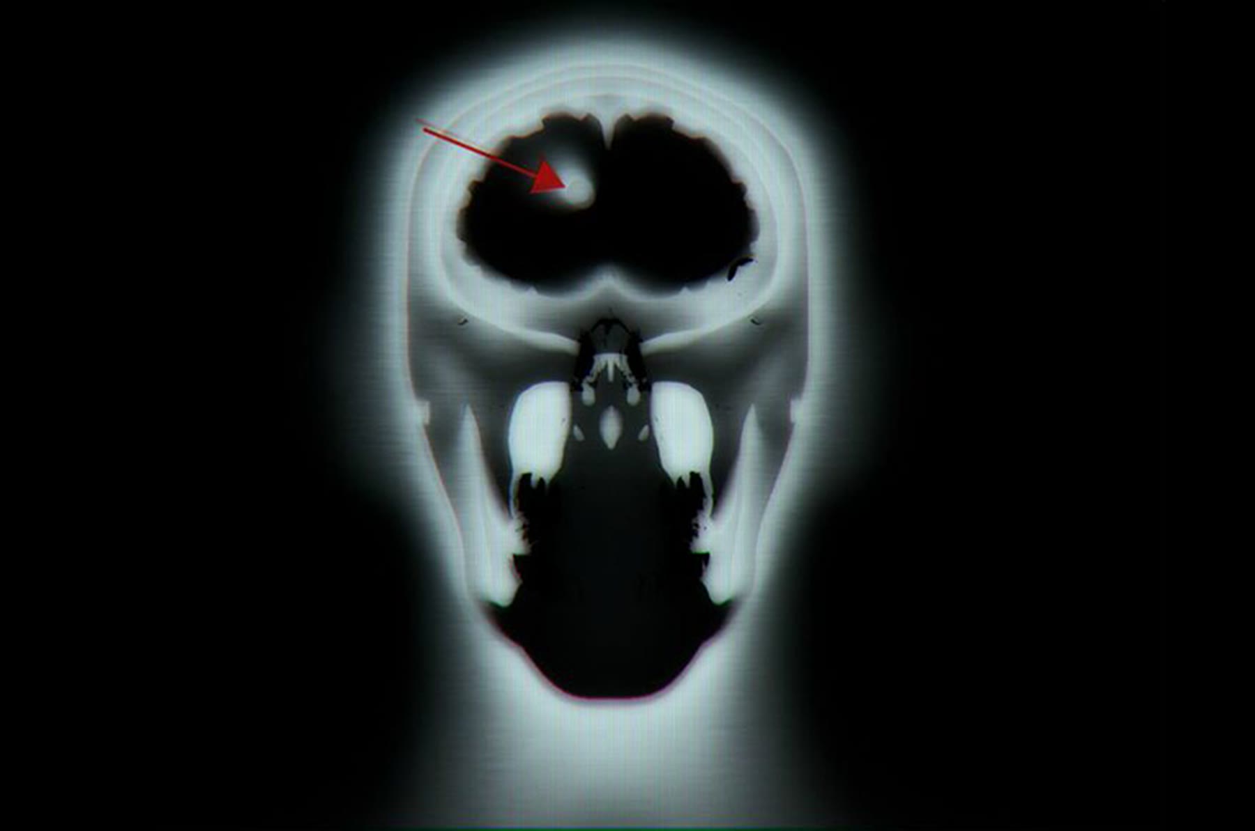 MRI scan of a head from the front