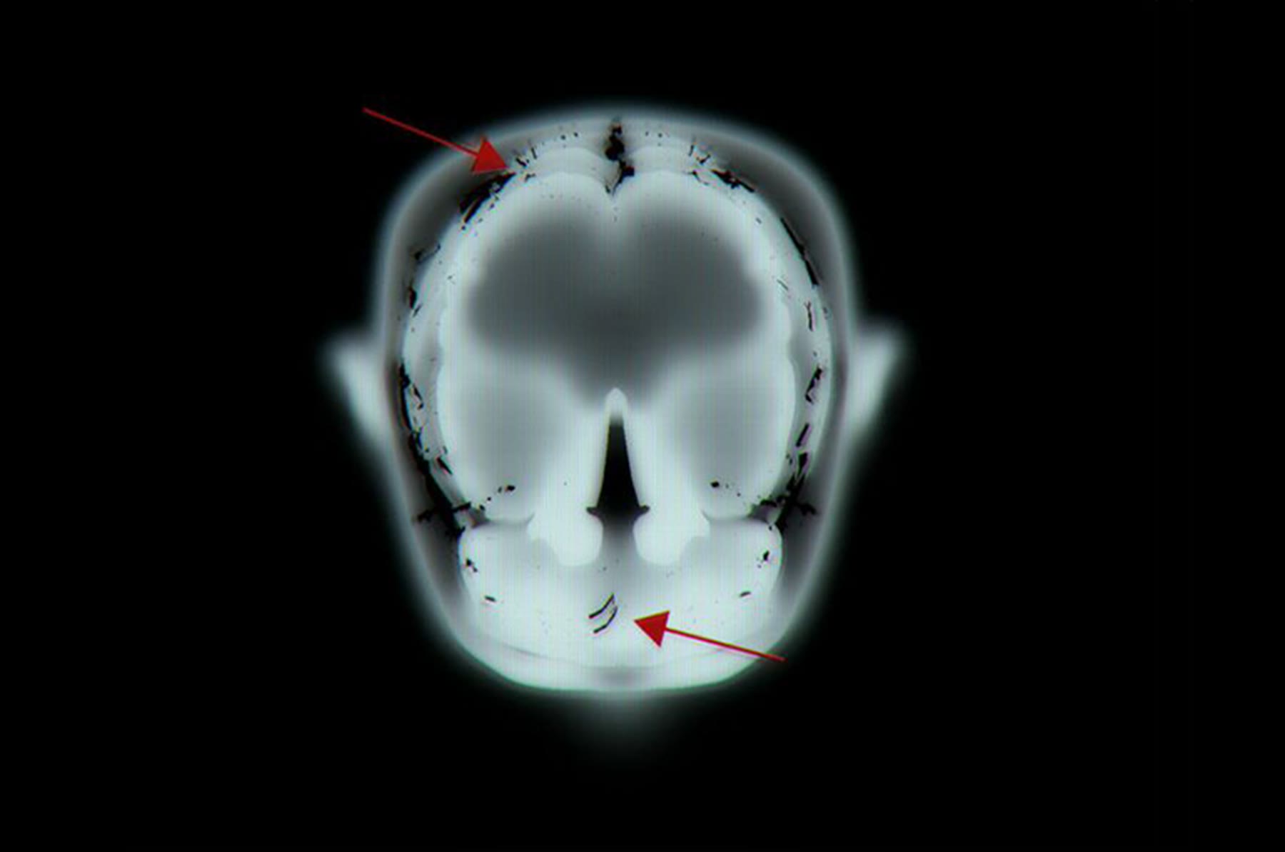 MRI cross-section with red markers
