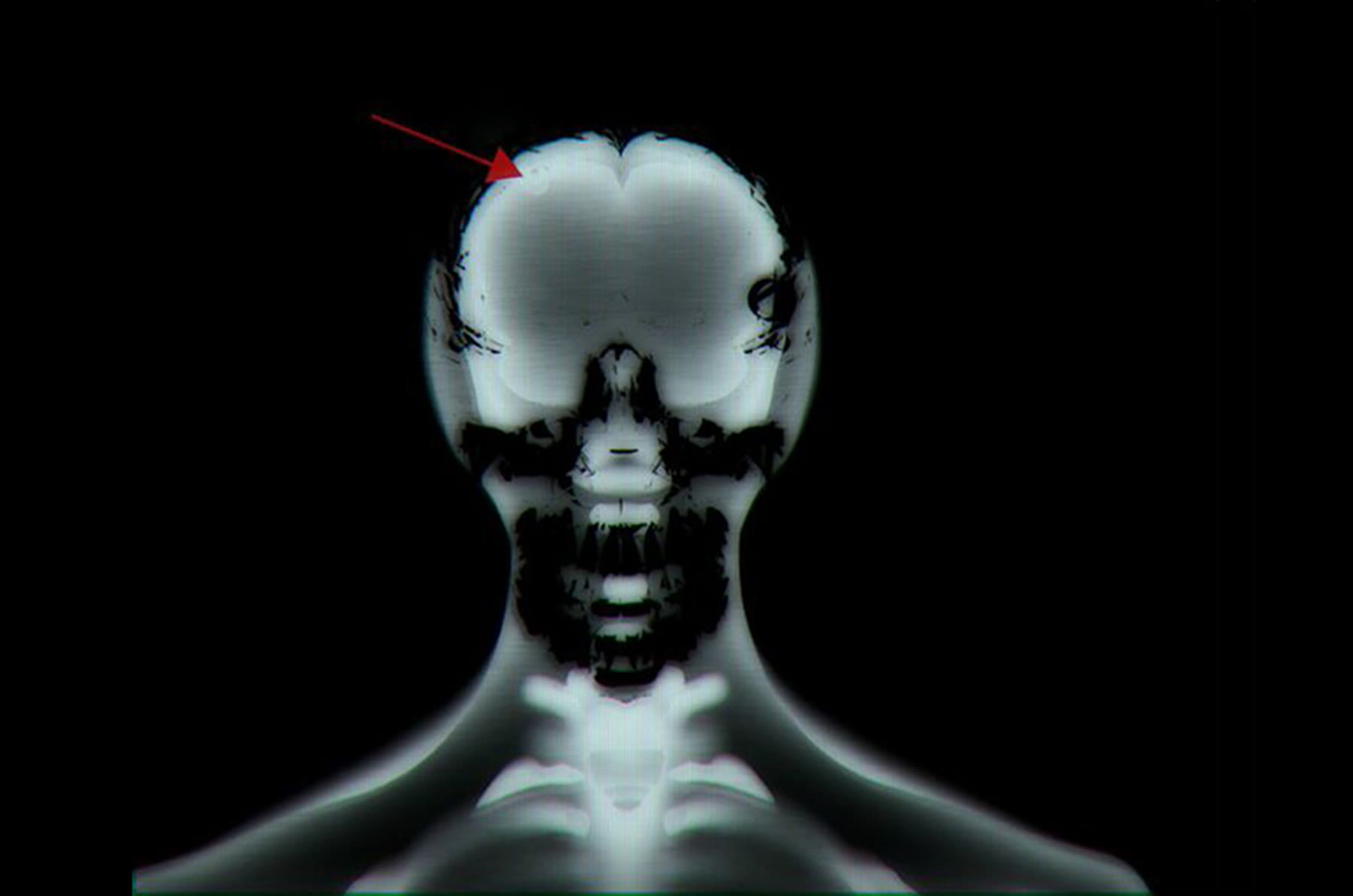 MRI scan of head and neck