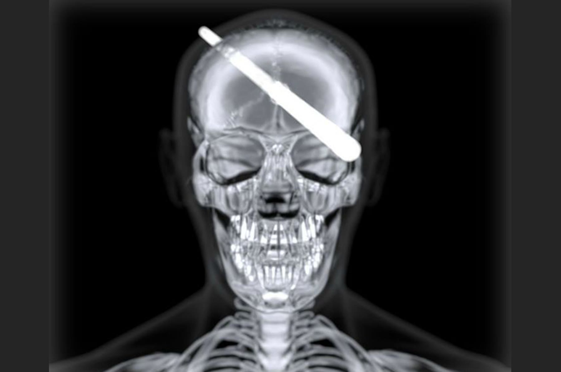 X-ray of a skull with a rod through it