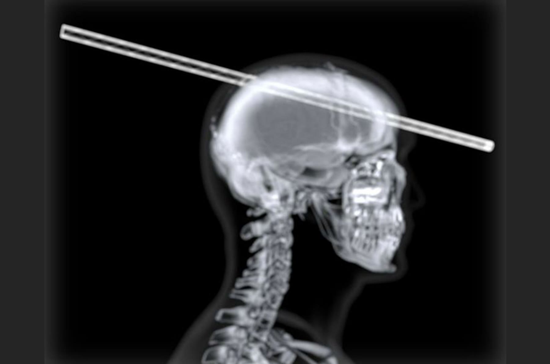 Side X-ray of the skull and rod