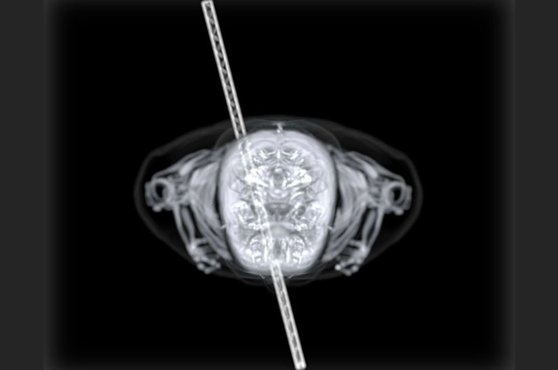 Top-down X-ray of the skull and rod