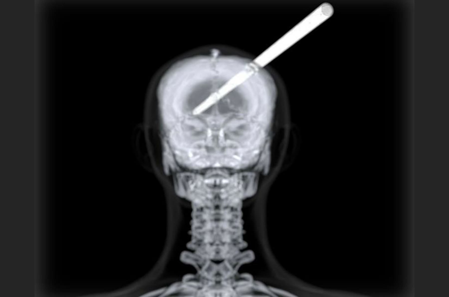 Angled X-ray of the skull and rod